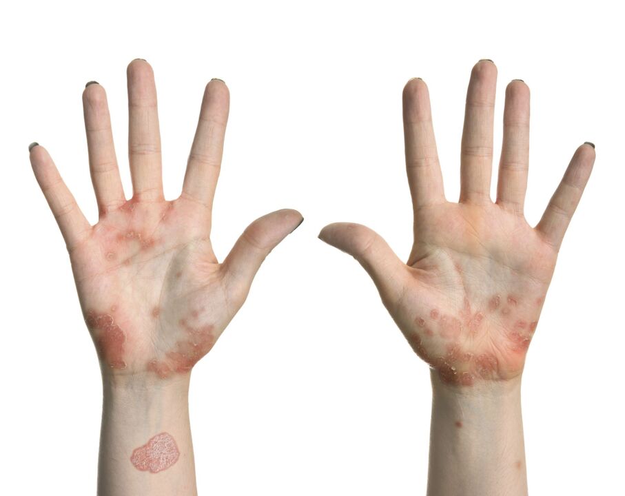 Psoriasia eskuetan